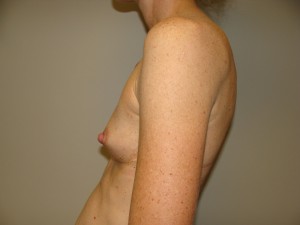 Breast Augmentation Before and After 272 | Grover Aesthetics