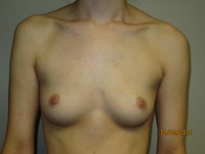Breast Augmentation Before and After | Grover Aesthetics