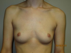 Breast Augmentation Before and After 189 | Sanjay Grover MD FACS