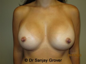 Breast Augmentation Before and After 273 | Sanjay Grover MD FACS
