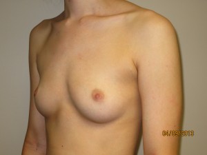 Breast Augmentation Before and After 273 | Grover Aesthetics