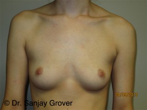 Breast Augmentation Before and After | Grover Aesthetics
