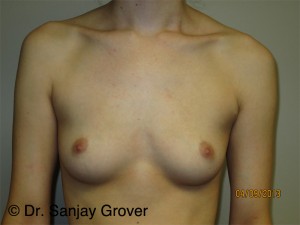 Breast Augmentation Before and After 311 | Sanjay Grover MD FACS