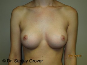 Breast Augmentation Before and After | Sanjay Grover MD FACS