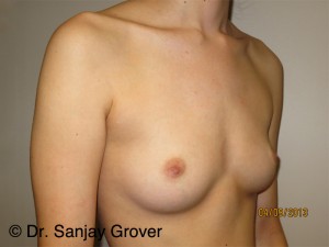 Breast Augmentation Before and After 275 | Grover Aesthetics