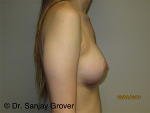 Breast Augmentation Before and After 275 | Grover Aesthetics
