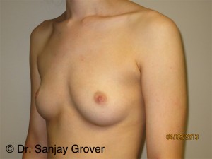 Breast Augmentation Before and After 275 | Grover Aesthetics