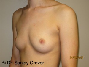 Breast Augmentation Before and After 275 | Sanjay Grover MD FACS