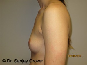 Breast Augmentation Before and After 275 | Grover Aesthetics