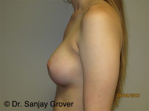 Breast Augmentation Before and After 275 | Grover Aesthetics