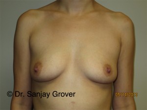 Breast Augmentation Before and After 312 | Sanjay Grover MD FACS