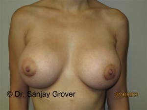 Breast Augmentation Before and After 276 | Sanjay Grover MD FACS