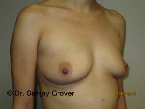 Breast Augmentation Before and After 276 | Sanjay Grover MD FACS