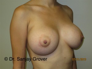 Breast Augmentation Before and After 276 | Grover Aesthetics