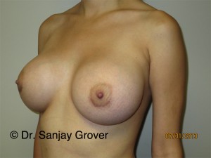 Breast Augmentation Before and After 276 | Grover Aesthetics