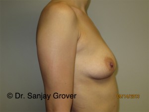 Breast Augmentation Before and After 276 | Grover Aesthetics