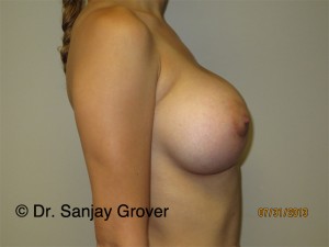 Breast Augmentation Before and After 276 | Grover Aesthetics