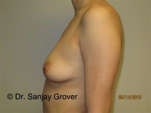 Breast Augmentation Before and After 276 | Grover Aesthetics