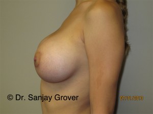 Breast Augmentation Before and After 276 | Grover Aesthetics