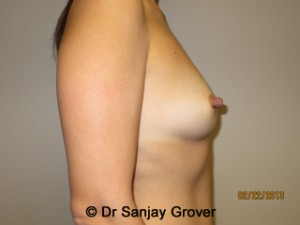 Breast Augmentation Before and After 277 | Grover Aesthetics