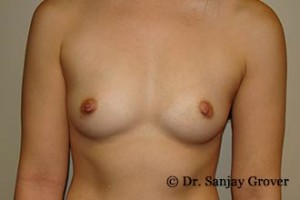 Breast Augmentation Before and After 134 | Sanjay Grover MD FACS