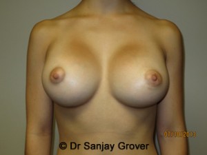 Breast Augmentation Before and After | Sanjay Grover MD FACS