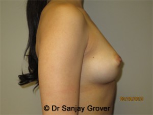 Breast Augmentation Before and After 278 | Grover Aesthetics