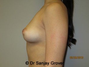 Breast Augmentation Before and After 278 | Grover Aesthetics