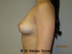 Breast Augmentation Before and After 278 | Sanjay Grover MD FACS