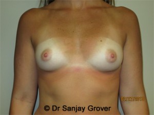 Breast Augmentation Before and After | Grover Aesthetics