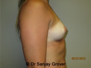 Breast Augmentation Before and After 279 | Grover Aesthetics