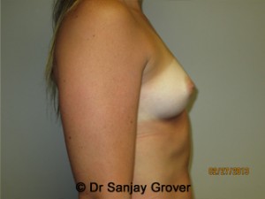 Breast Augmentation Before and After 279 | Sanjay Grover MD FACS