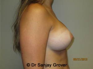 Breast Augmentation Before and After 279 | Grover Aesthetics