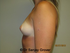 Breast Augmentation Before and After 279 | Grover Aesthetics