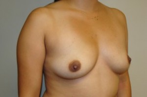 Breast Augmentation Before and After 28 | Sanjay Grover MD FACS