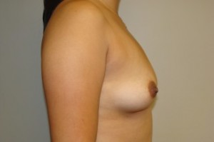 Breast Augmentation Before and After 28 | Grover Aesthetics