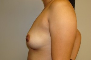 Breast Augmentation Before and After 28 | Grover Aesthetics