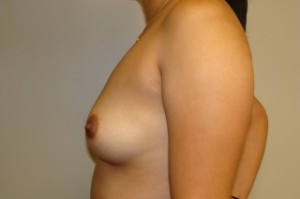 Breast Augmentation Before and After 28 | Sanjay Grover MD FACS