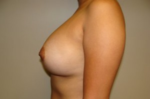Breast Augmentation Before and After 28 | Grover Aesthetics