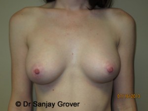Breast Augmentation Before and After | Grover Aesthetics