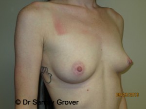 Breast Augmentation Before and After 280 | Grover Aesthetics