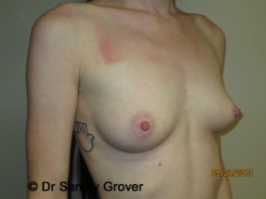 Breast Augmentation Before and After 280 | Sanjay Grover MD FACS