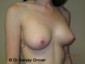 Breast Augmentation Before and After 280 | Grover Aesthetics
