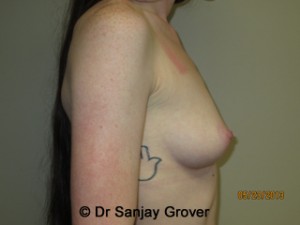 Breast Augmentation Before and After 280 | Sanjay Grover MD FACS