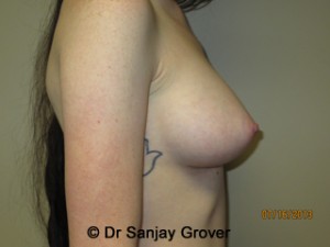 Breast Augmentation Before and After 280 | Grover Aesthetics