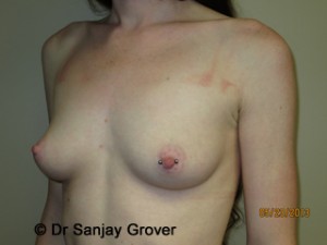 Breast Augmentation Before and After 280 | Grover Aesthetics