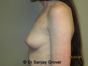 Breast Augmentation Before and After 280 | Grover Aesthetics