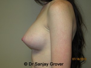 Breast Augmentation Before and After 280 | Grover Aesthetics