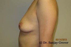 Breast Augmentation Before and After 281 | Grover Aesthetics