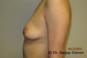 Breast Augmentation Before and After 281 | Sanjay Grover MD FACS